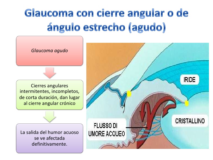 Glaucoma de ángulo cerrado o estrecho