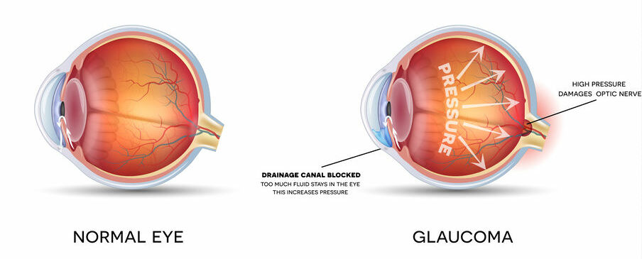 Síntomas Del Glaucoma Global Glaucoma Institute 5011