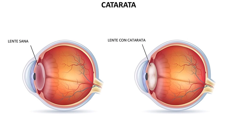 Catarata-e1618594721793-NUEVO