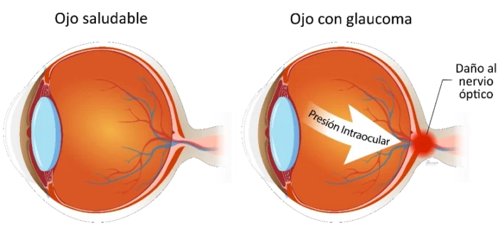 Ojo-con-galucoma-y-ojo-saludable-800x395-1-NUEVO Ojo-con-galucoma-y-ojo-saludable-800x395-1-NUEVO