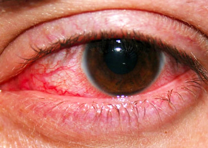 inflamacion-ocular-1-NUEVO