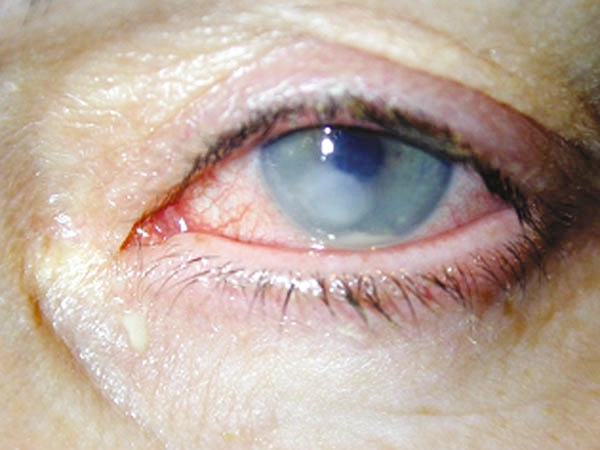 ulcera-corneal-NUEVO