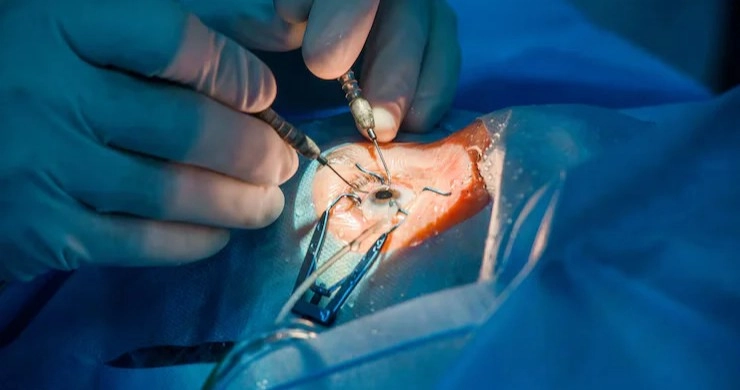 operacion-trabeculectomia-glaucoma